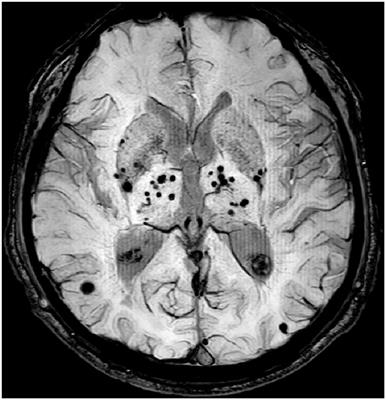 Lobar Cerebral Microbleeds Are Associated With Cognitive Decline in Patients With Type 2 Diabetes Mellitus